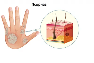 Лечение моего псориаза | Пикабу