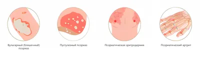 На меня все смотрят косо. Томич рассказал, как живет с псориазом | ОБЩЕСТВО  | АиФ Томск