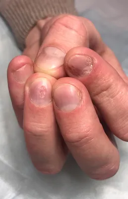 Лечение псориаза ногтей в Москве – лечение ногтей на руках и ногах в  клинике MedNail