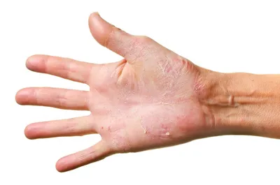 Псориаз на руках: фото. Псориаз начальной стадии на пальцах рук.