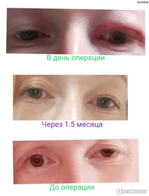 ОПУЩЕНИЕ ВЕРХНЕГО ВЕКА (ПТОЗ ВЕКА)... - MEDAS Medical Center | Facebook