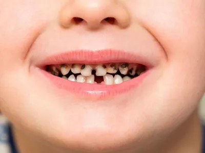 Пульпит молочных зубов у детей фото фотографии