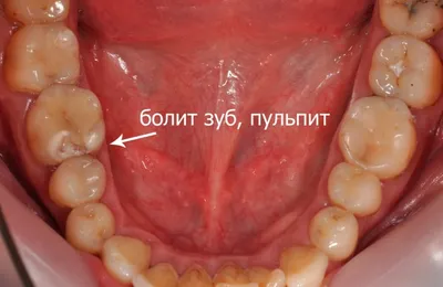 Пульпит - диагностика и качественное лечение в Харькове