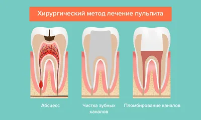 Лечение пульпита по низким ценам. Симптомы и методы лечения | НоваДент