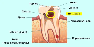 Лечение пульпита в Ивантеевке - симптомы, причины и лечение в «КАС+»