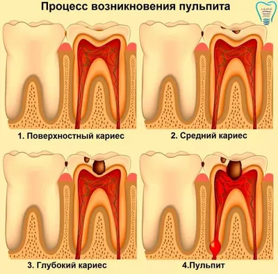 Почему Возникает Пульпит и Как он Лечится? — Клиника Лукашука