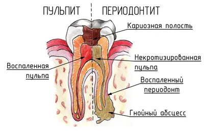 Лечение пульпита Екатеринбург от 7000 руб недорого | Цены на лечение  пульпита