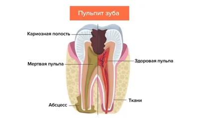 Периодонтит и пульпит: особенности лечения