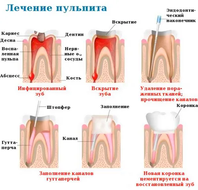 Пульпит - диагностика и качественное лечение в Харькове