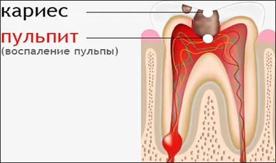 Лечение пульпита - симптомы и последствия пульпита | Профилактика