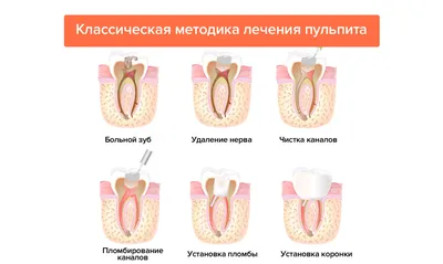 Лечение пульпита - воспаления нерва - Стоматологическая Клиника МК ДЕНТ