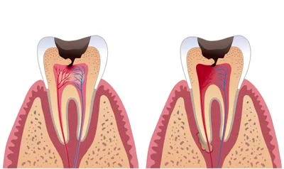 Лечение пульпита - Стоматологическая клиника VИТАЛЬ