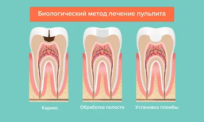 Пульпит - причины развития, классификация, симптоматика, диагностика и  лечение