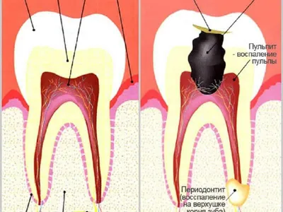 Лечение пульпита в Минске, цена лечения глубокого пульпита зуба
