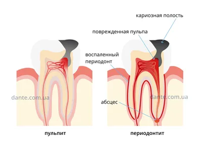 Пульпит или периодонтит? / Лечение зубов / Блог