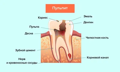 Пульпит зуба: классификация, лечение и удаление