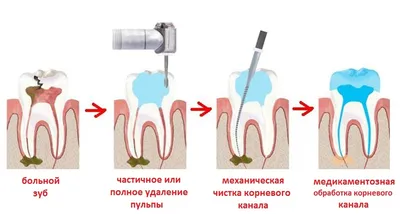 Лечение пульпита трехканального зуба в Москве: цена лечения в сети  стоматологий OneDent