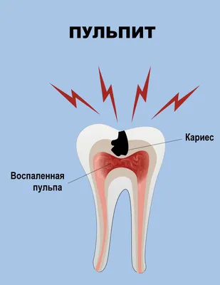 Пульпит: симптомы и лечение | Центр стоматологии «Ваш Стоматолог»