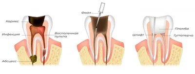 Лечение пульпита в Кургане: причины возникновения и потенциальная опасность  | Космодент