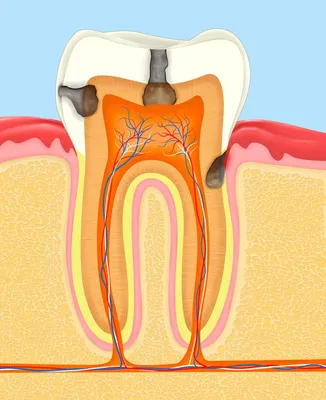 Пульпит | Стоматология Бескудниково