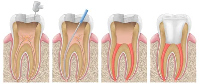 Пульпит и его лечение - стоматология Мастер клиник в г.Бресте