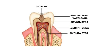 Лечение пульпита, как этап комплексного лечения