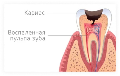 Кариес или пульпит - признаки и способы лечения | РКСП