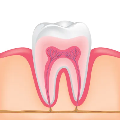 Пульпит зуба: симптомы и как его лечат