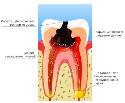 Пульпит зуба: лечение, симптомы, цены на лечение каналов в стоматологии —  ROOTT