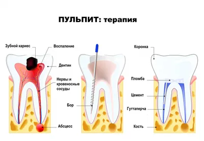 Лечение зубных каналов: пульпит, периодонтит - клиника Прайдент