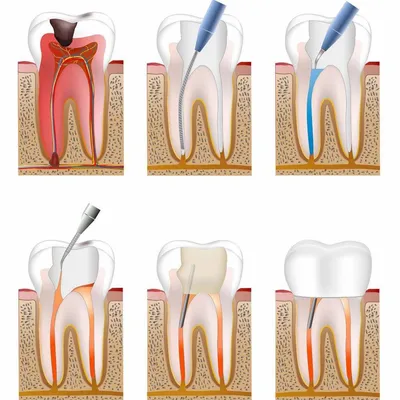 Лечение по поводу пульпита