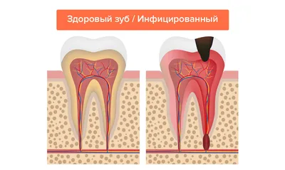 Пульпит - причины появления, симптомы заболевания, диагностика и способы  лечения