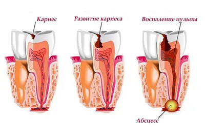 Пульпит симптомы и причины: современные методы лечения
