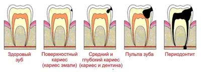 Лечение пульпита в стоматологии спб Dental House