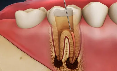 Пульпит зуба: причины появления, симптомы заболевания, диагностика,  профилактика и лечение в стоматологии