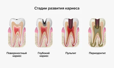 Пульпит|Стоматологический центр Иркутск