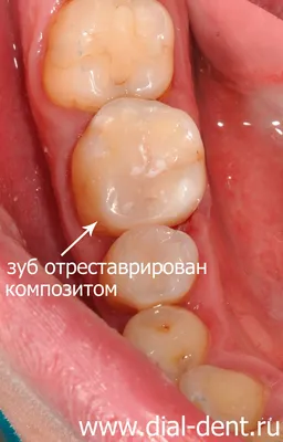 Симптоматический пульпит – лечение зуба с микроскопом