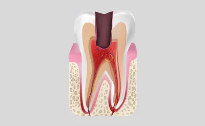 Болезнь пульпит (воспаление внутренней ткани зуба) - стоматология «Дентко»