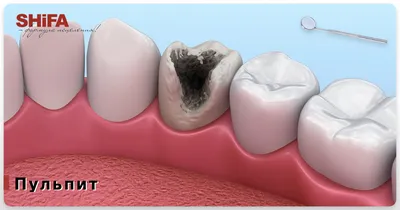 Пульпит : справочник стоматологических заболеваний