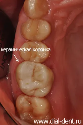 Лечение хронического пульпита и реставрация зуба керамической коронкой
