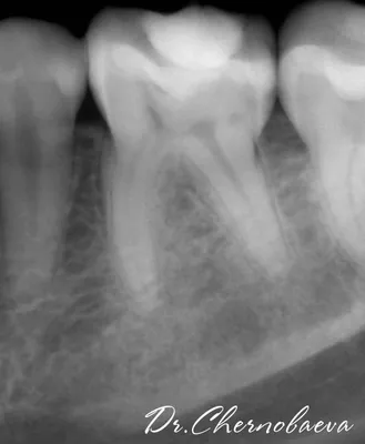 Хронический пульпит 3.6 зуба в обострении | АктивСтом