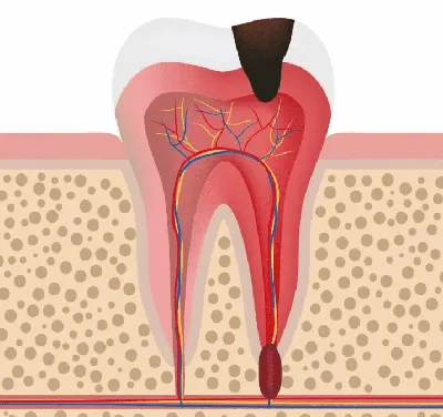 Что такое пульпит | Клиника Колибри