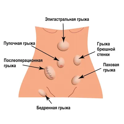 Удаление пупочной грыжи – «Dekamedical» Клиника в Москве.