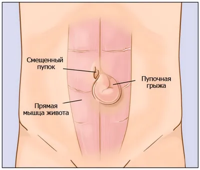 ПЛАСТИКА ПУПКОВОГО КІЛЬЦЯ — Клініка «РоміТаль»