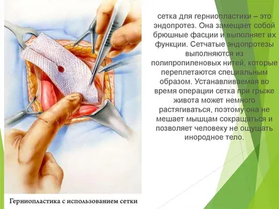 Операция по удалению пупочной грыжи (герниопластика) у мужчин и женщин:  питание после лечения, как делают операцию, реабилитация