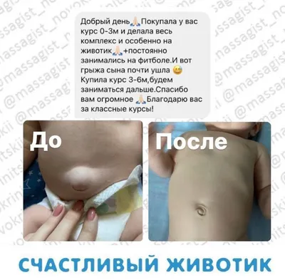 Пупочные грыжи, грыжи белой линии живота и диастаз прямых мышц живота |  Украинский центр хирургического лечения грыж живота