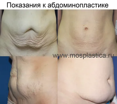 Живот после родов: руководство к действию