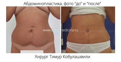 Пластика живота после родов (операция абдоминопластика) → Ваш лучший  пластический хирург - Андрей Леонидович Харьков в Вене, Лондоне, Цюрихе