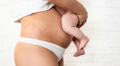 Как ухаживать за пупком новорожденного – Heinz Baby