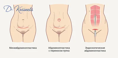 Revers абдоминопластика в Москве - цены, отзывы, реальные фото до и после |  Александр Маркушин пластический хирург